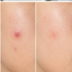 محلول/کرم موضعی ضدجوش نو آکنه NO Acne SOS | درمان موضعی جوش و لک جای جوش